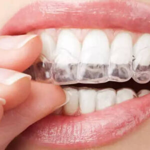 Do Ultrasonic Retainer Cleaners Work? What You Need to Know Before You Buy